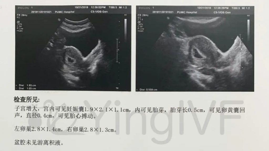 日本英医院生殖中心的日本试管婴儿微刺激方案和三代试管婴儿技术成功率