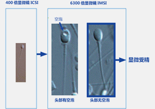 体外受精